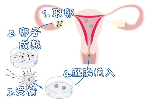 凍結胚移植